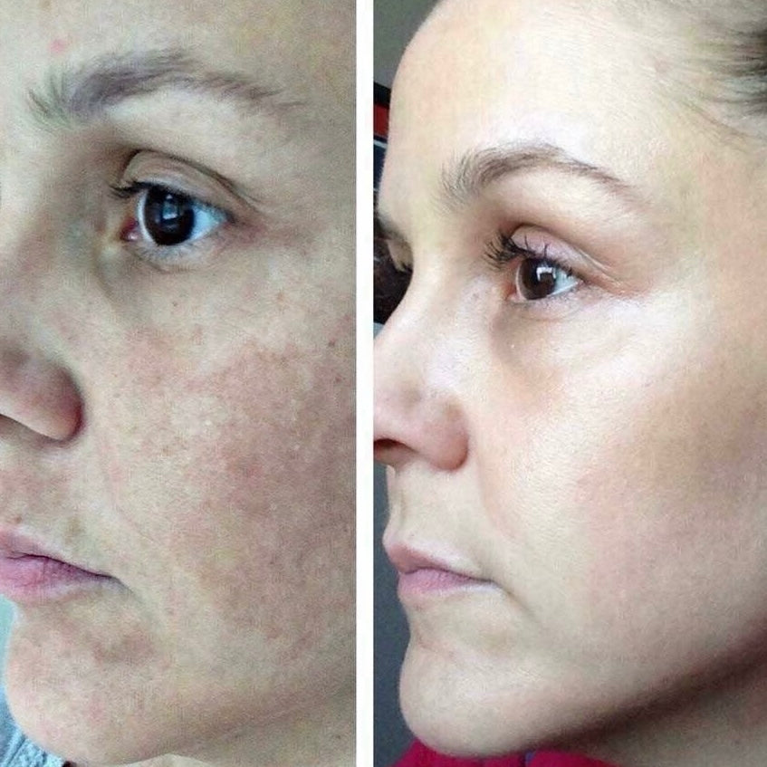 Avant après avoir utilisé l’exfoliant à la canneberge 